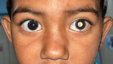 Retinoblastoma