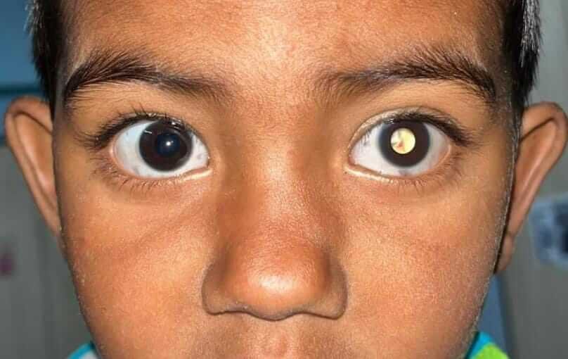 Retinoblastoma