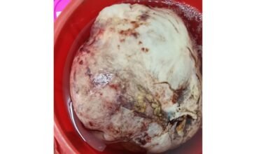 महिला-के-पेट-से-निकाला-20-किलो-का-ट्यूमर-