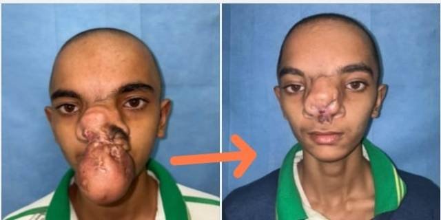 गणेश-के-चेहरे-की-लौटी-मुस्कान-मिला-जीवनदान-thecoverage