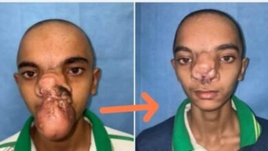 गणेश-के-चेहरे-की-लौटी-मुस्कान-मिला-जीवनदान-thecoverage