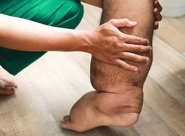 Filariasis Disease the coverage